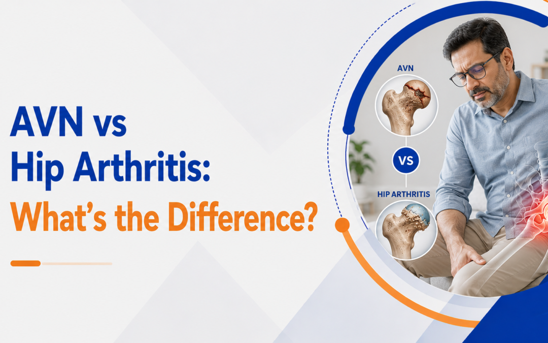 AVN vs Hip Arthritis: What’s the Difference?