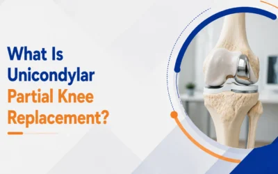 What Is Unicondylar Partial Knee Replacement?