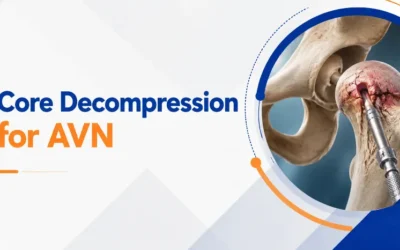 Core Decompression for AVN: Can It Help You Avoid Hip Replacement?