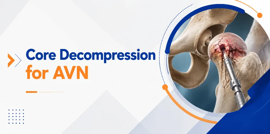 Core Decompression for AVN: Can It Help You Avoid Hip Replacement?