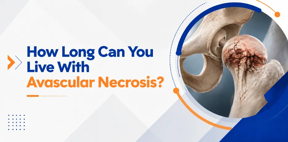 How Long Can You Live With Avascular Necrosis?