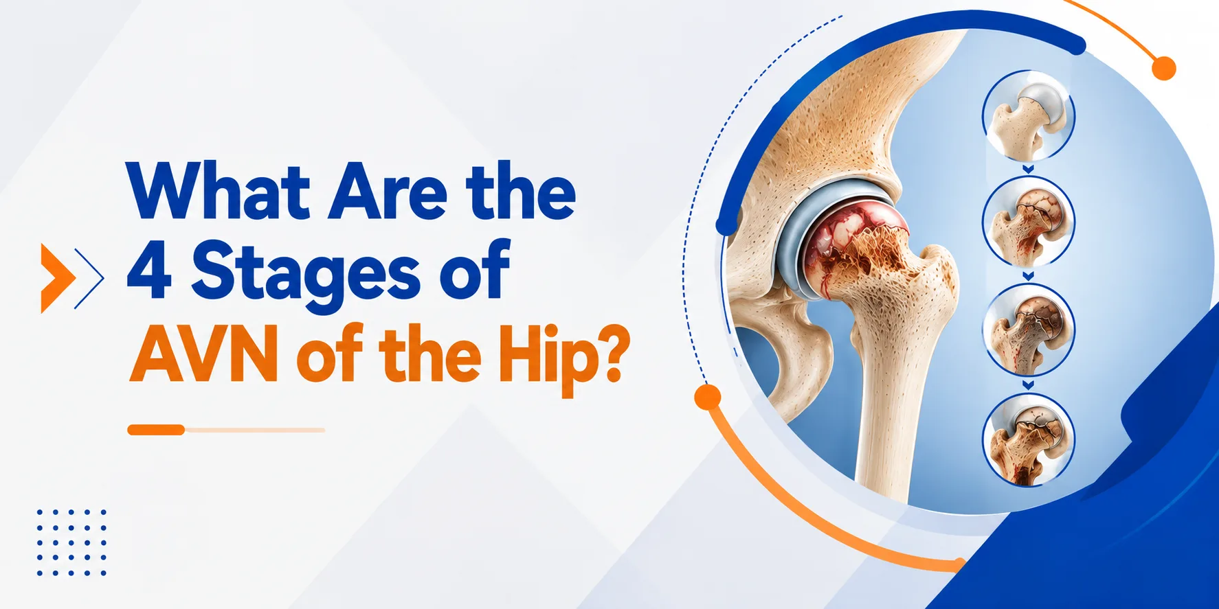 What Are the 4 Stages of AVN of the Hip?